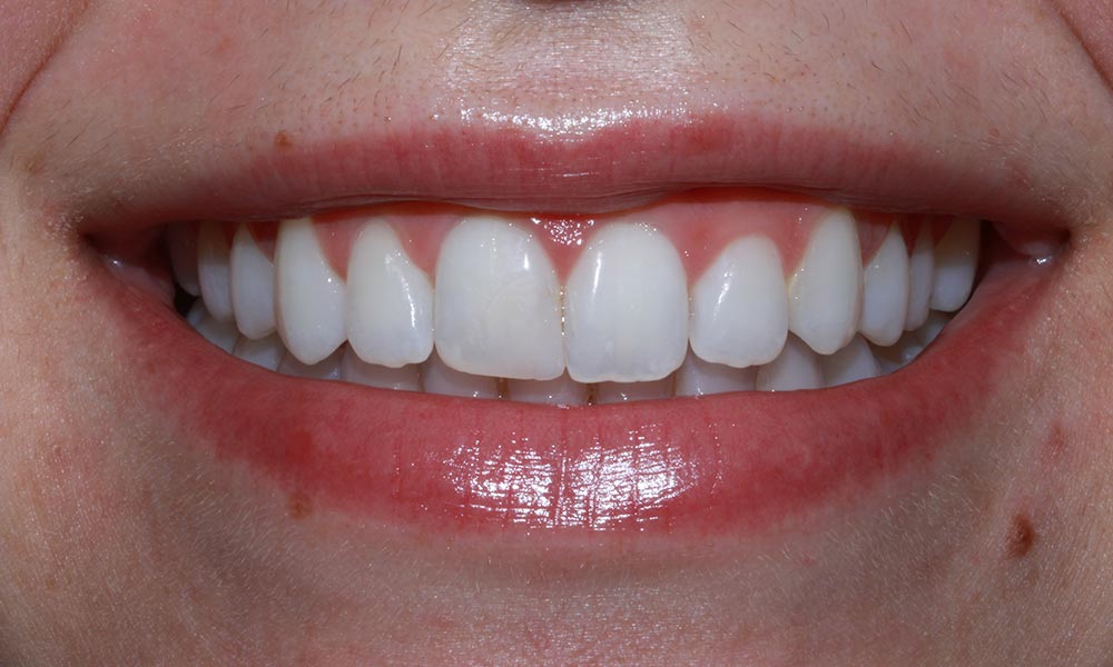 After smile makeover picture showing smiling mouth with bright, white teeth