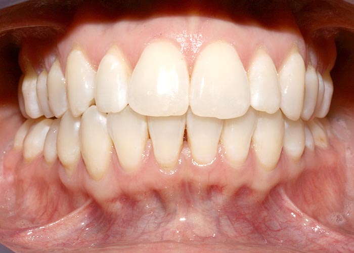 After orthodontics picture showing the straightened teeth of happy patient