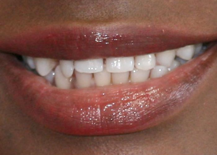 Before orthodontics treatment picture showing misaligned teeth