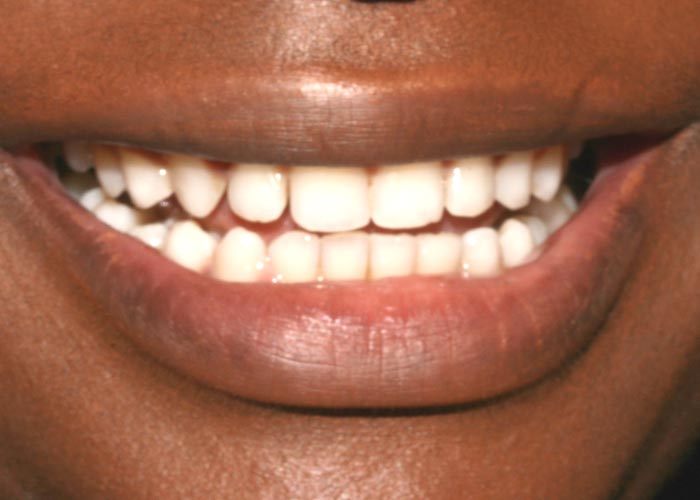 After treatment picture showing clean, straight teeth of happy and smiling patient