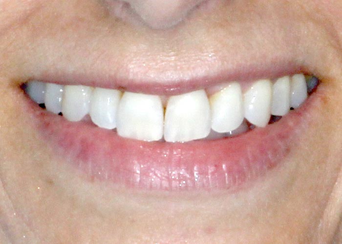 After orthodontic treatment of patient with dramatically straightened teeth