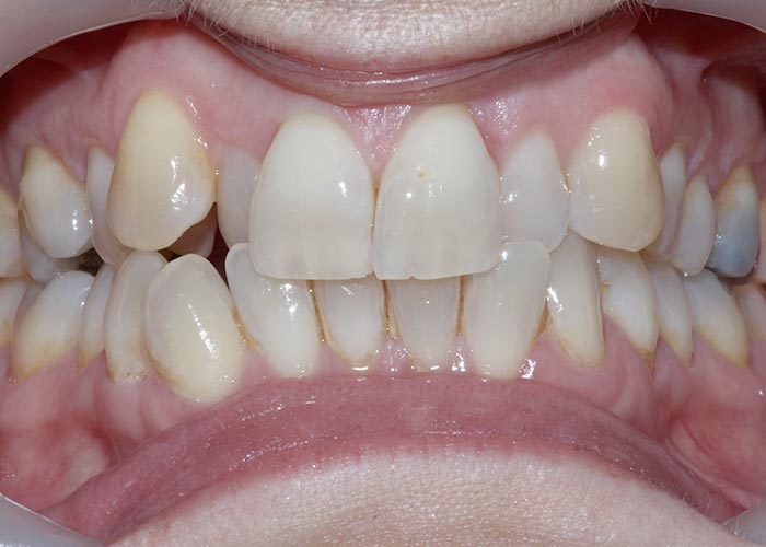 Before orthodontic treatment showing misaligned teeth of patient