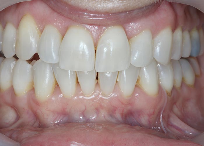 After orthodontic treatment showing straightened, clean teeth