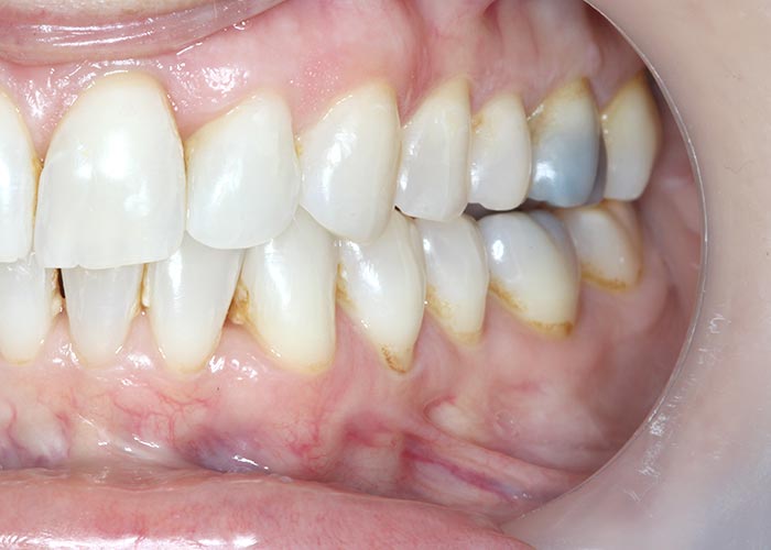 After orthodontic treatment picture showing straightened teeth