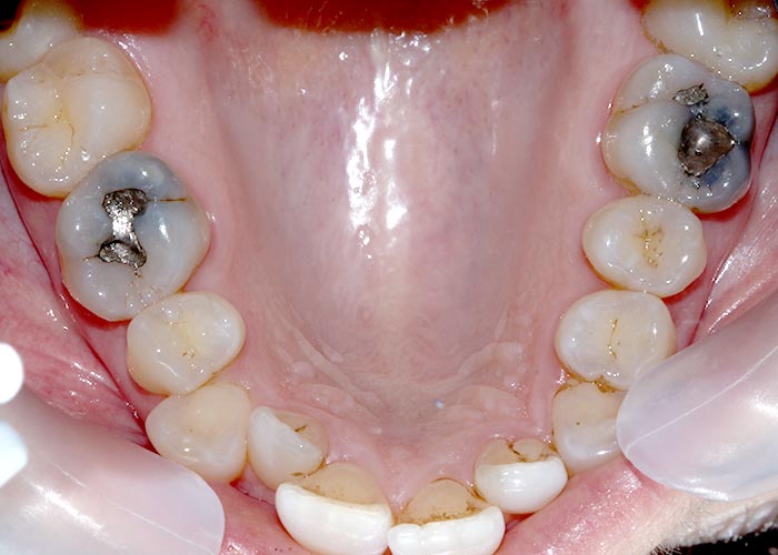 Patient's crooked and asymmetrical teeth - a before orthodontic treatment picture