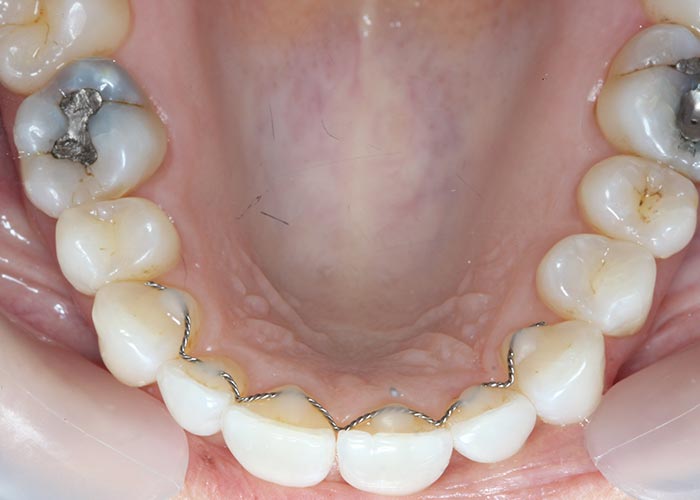 Patient's straightened bottom row of teeth after lingual orthodontic treatment