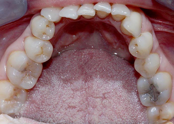 top row of crooked and overcrowded teeth before orthodontic treatment