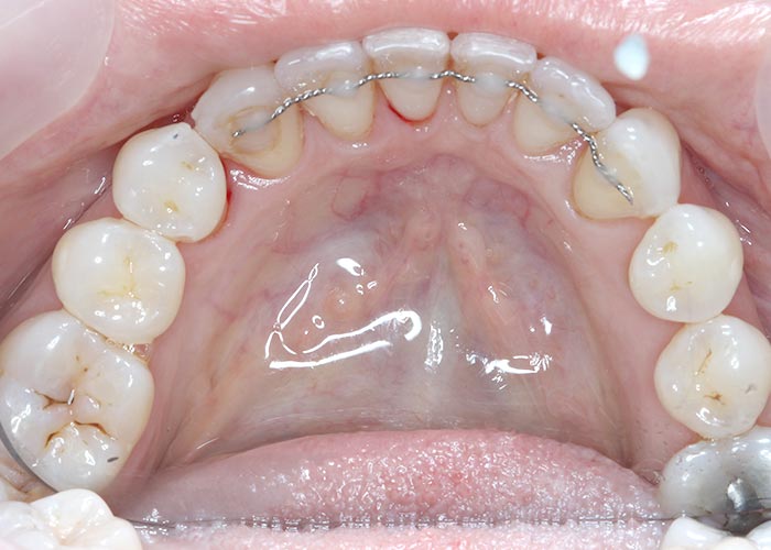 straightened top row of teeth after successful lingual orthodontic treatment