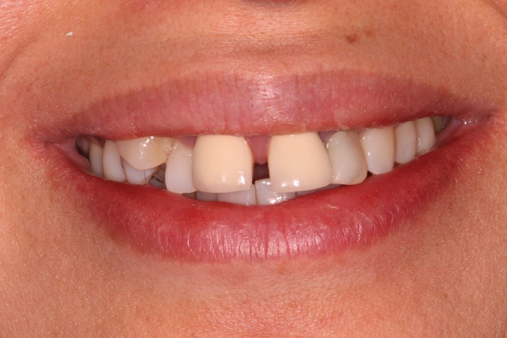 Dental Implants Lister House Dental Centre Essex Dentist