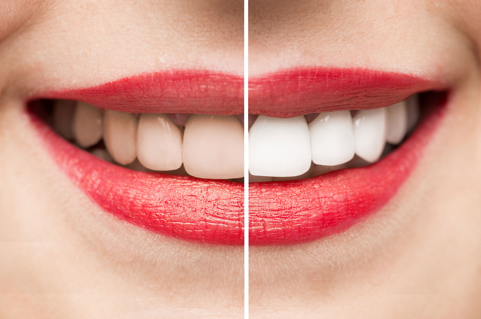 All You Need To Find Out About Laser Teeth Bleaching