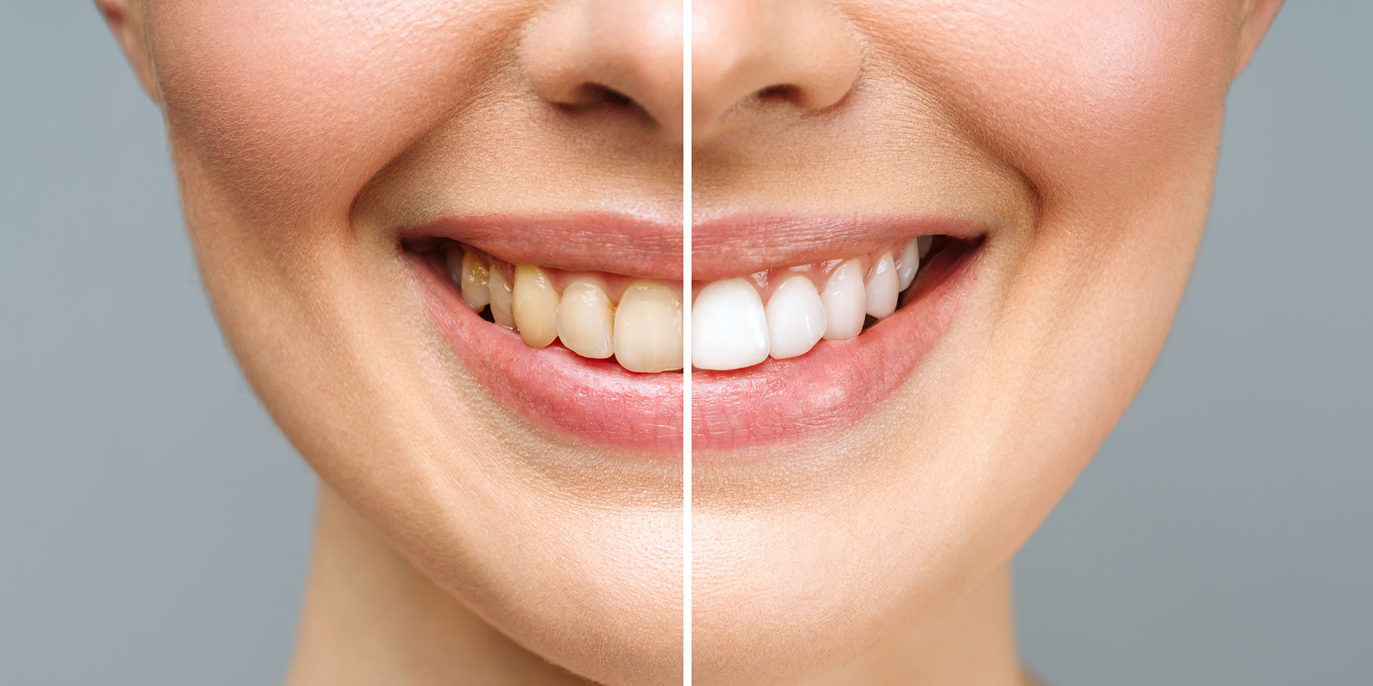 Teeth Whitening in Essex – Professionally Brighter Smiles