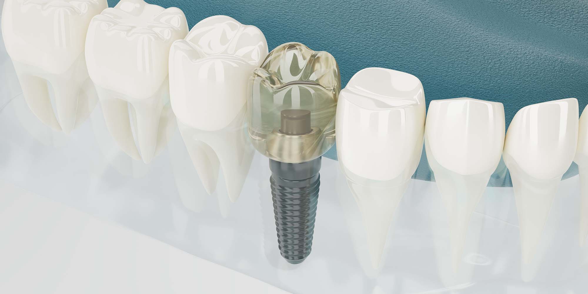 Affordable Dental Implants in Harlow, Essex