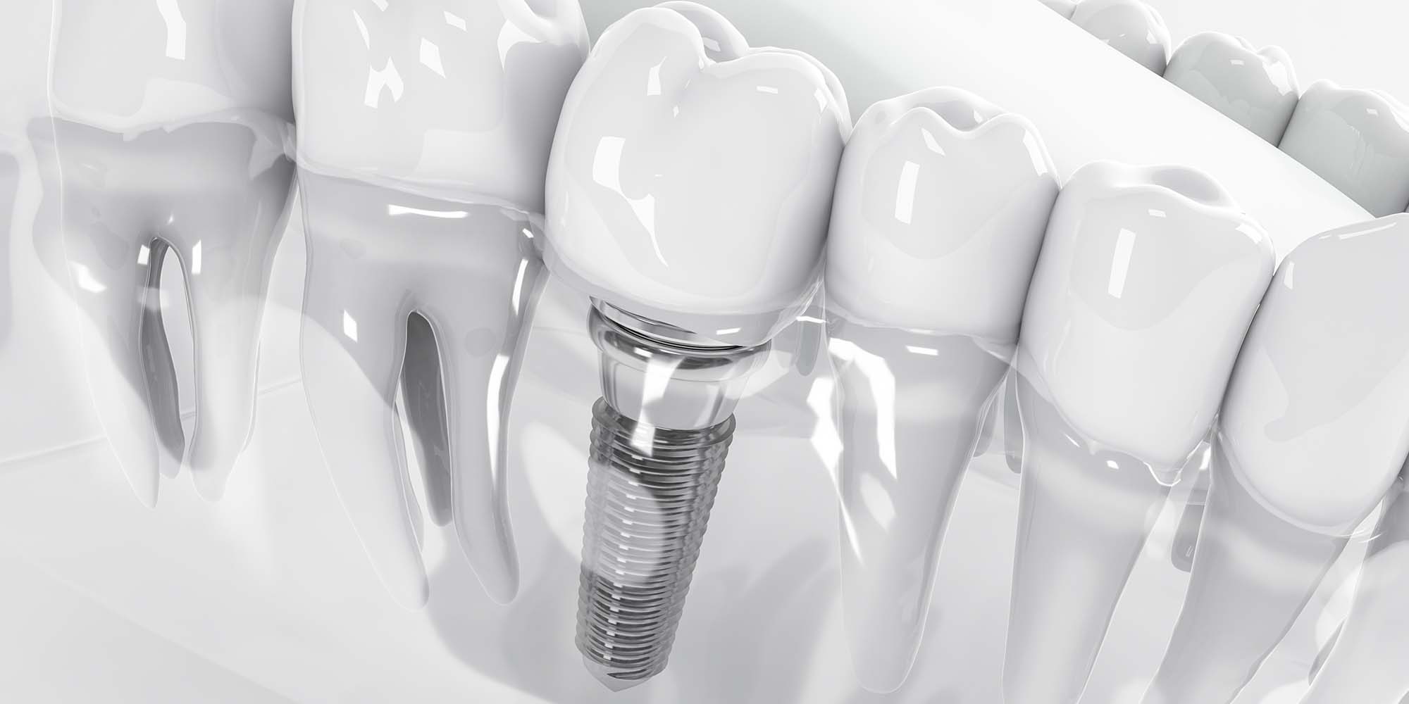 Replace Missing Teeth – Same Day Dental Implants in Essex