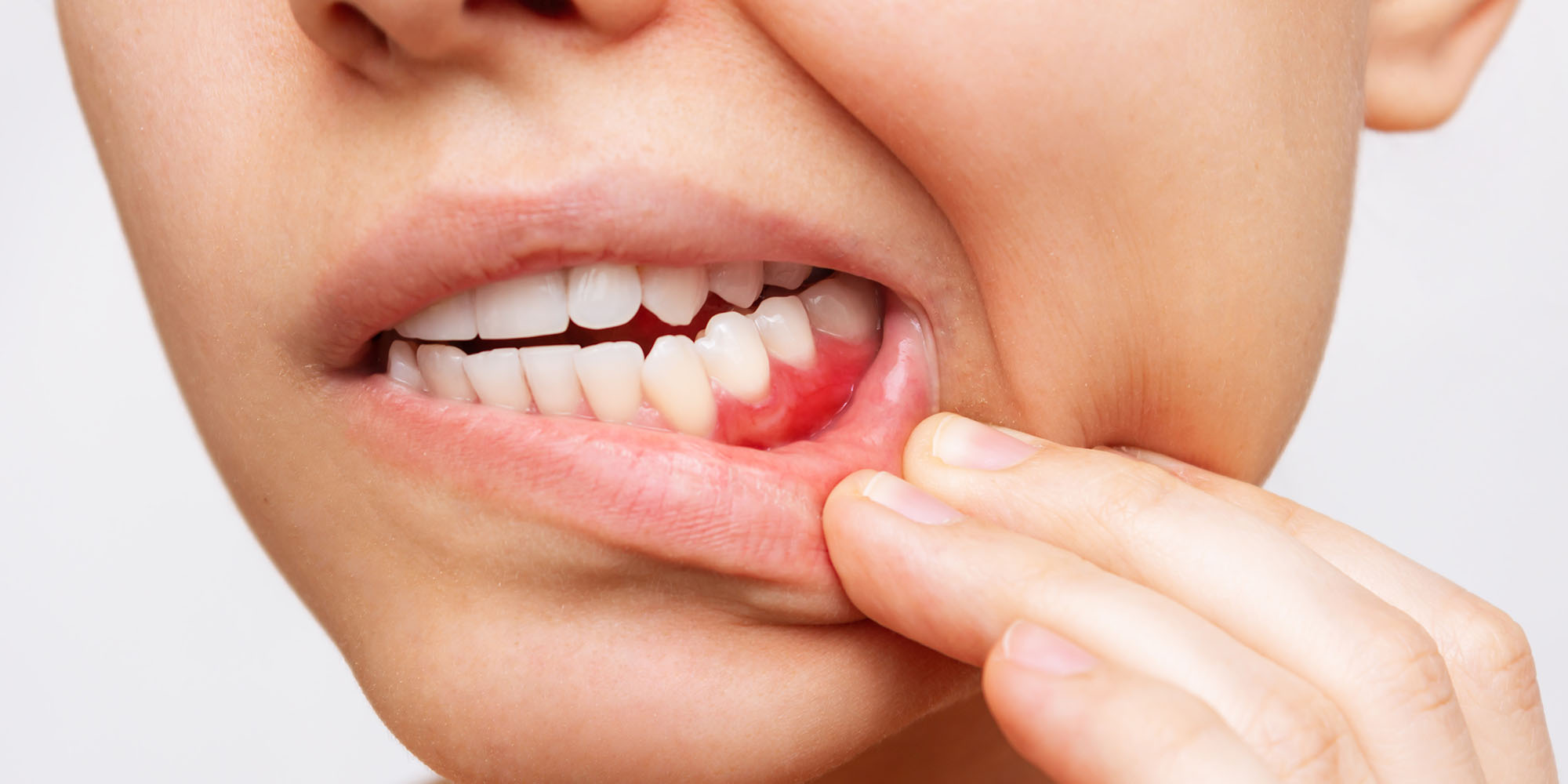‘Do I have gum disease?’ Periodontic Treatment in Essex